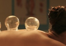 cupping
